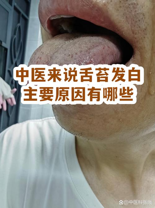 中医来说舌苔发白主要原因有哪些